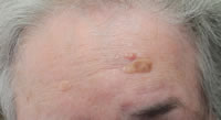 beforeTreatment of Brown Spots