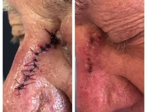 Surgical Removal Basal Cell Carcinoma